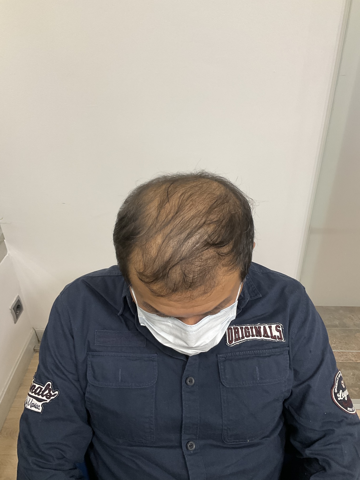 Alopecia andregenética tipo 1 antes del tratamiento