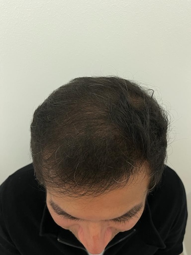 Resultado alopecia androgenética tipo 1 después de un año de tratamiento