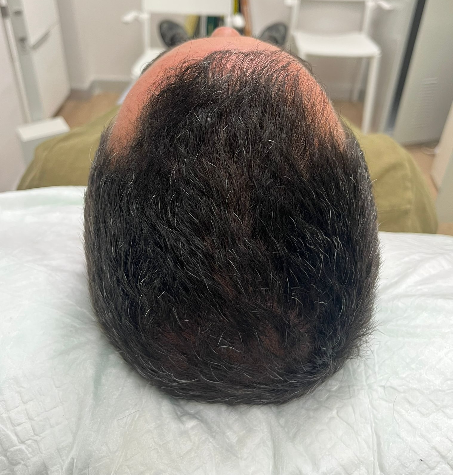 Alopecia tipo 2 después del tratamiento