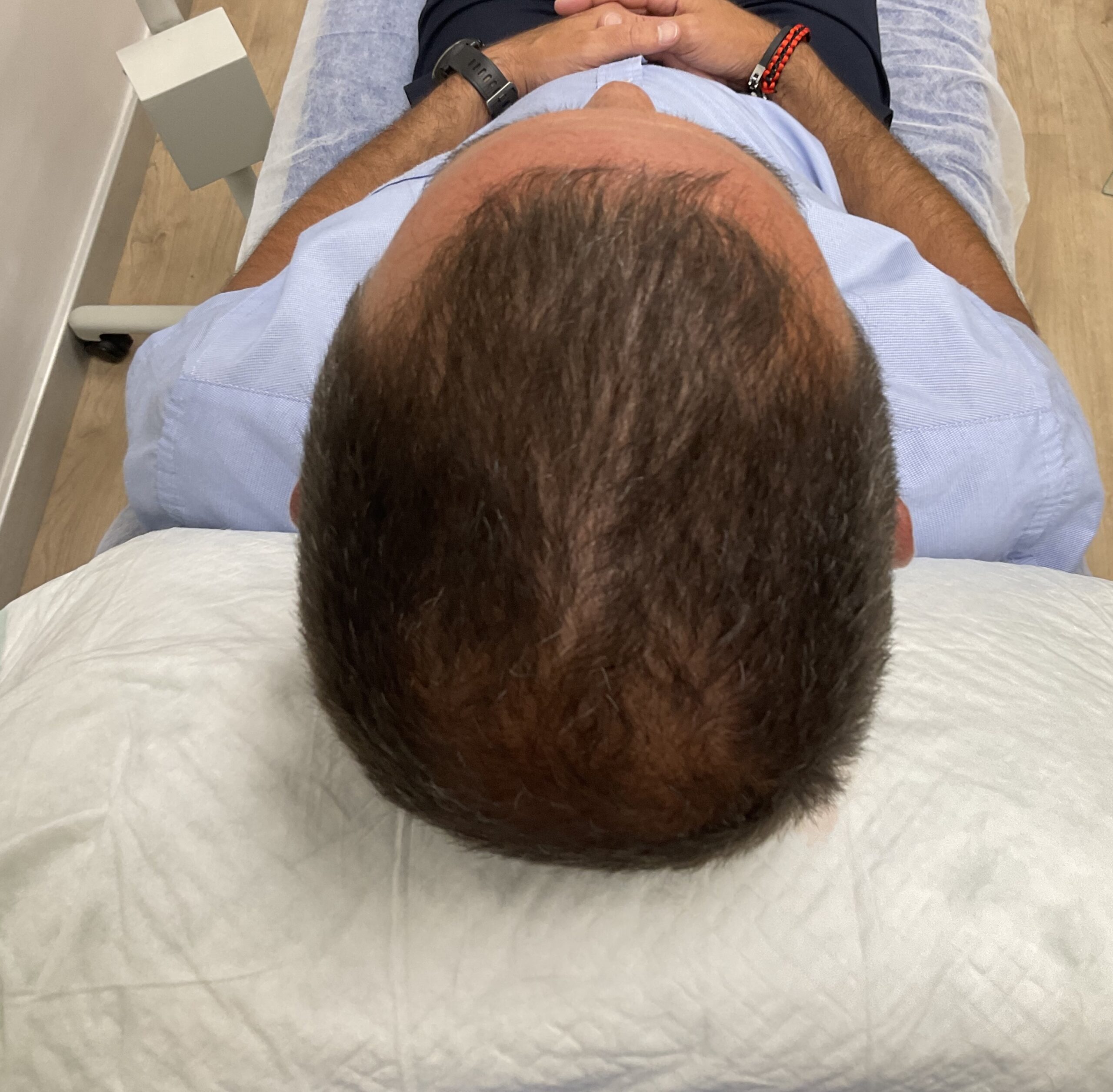 Alopecia tipo 2 coronilla