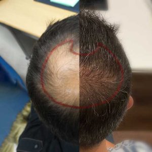 Cuántos-implantes-de-pelo-se-pueden-hacer