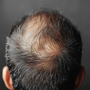 alopecia androgenética